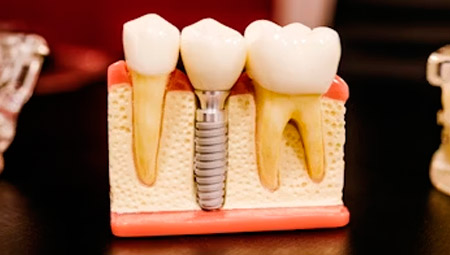 Foto Implantes - Dr. Alexandre Esteves