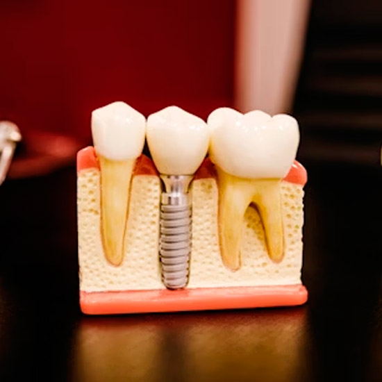 Foto Implantes (Implantodontia) - Dr. Alexandre Esteves